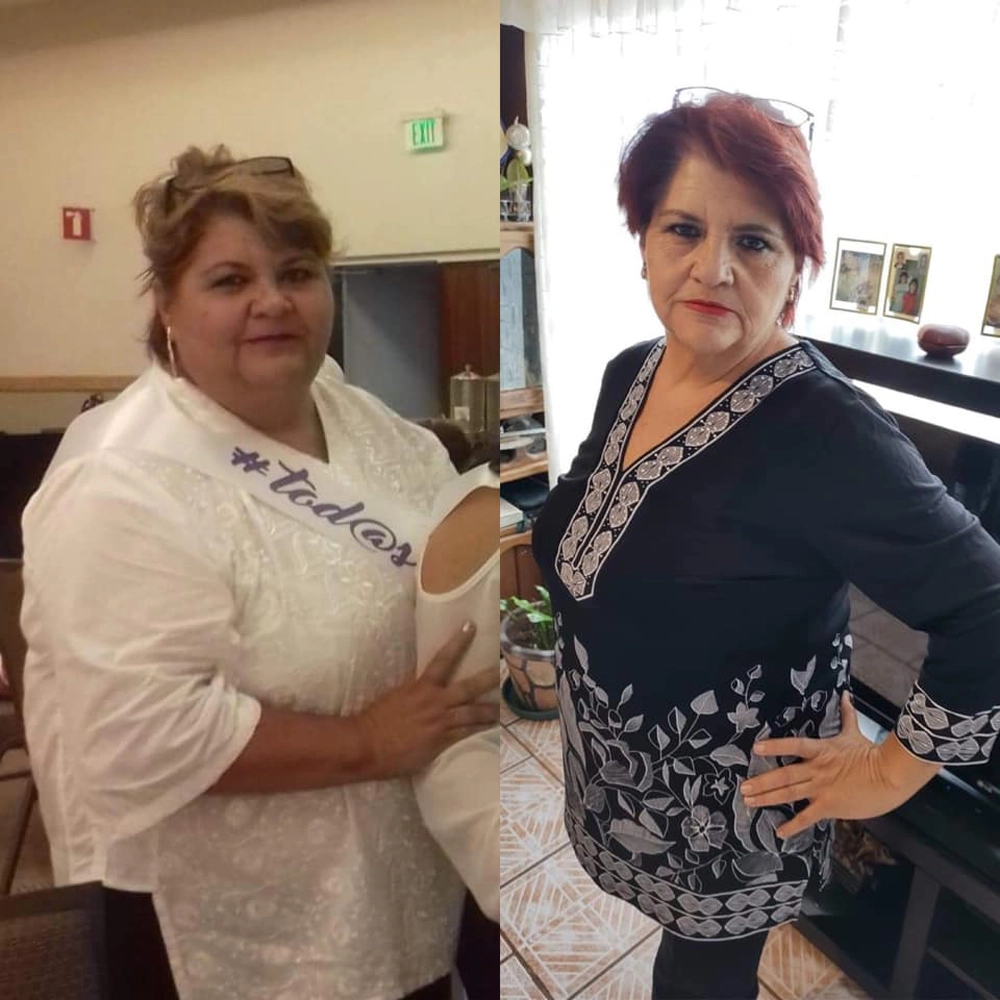 Antes y después de una paciente de la Dra. Sujey Romero