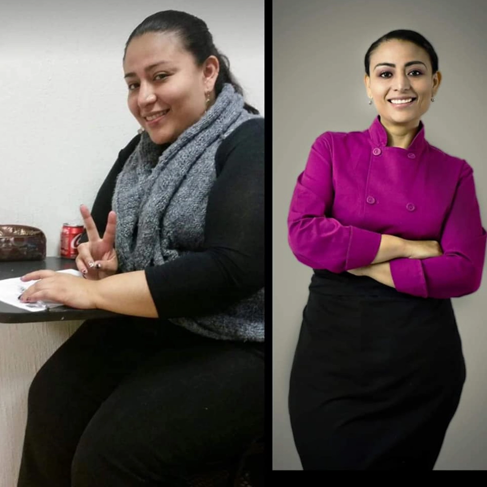 Antes y después de una paciente de la Dra. Sujey Romero