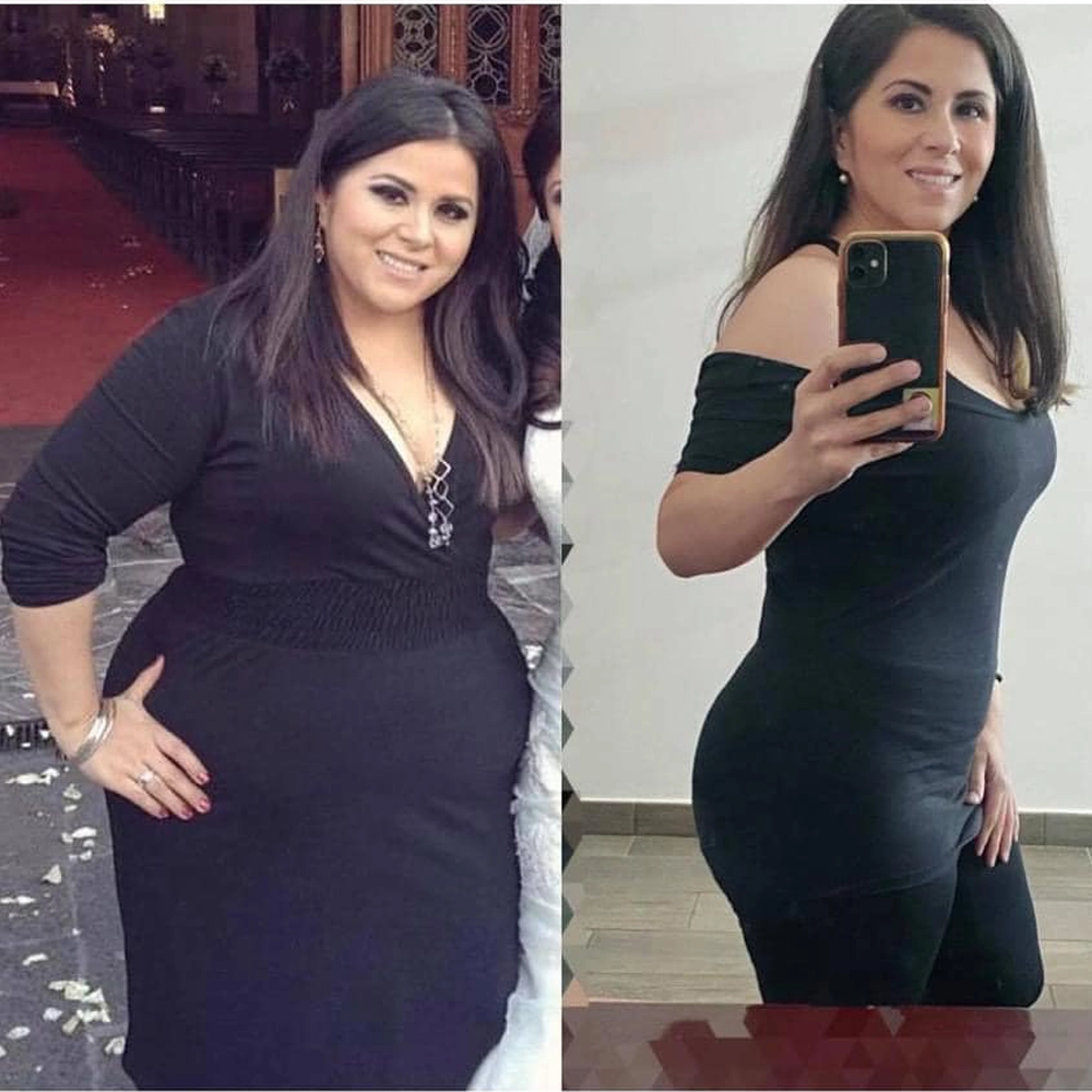 Antes y después de una paciente de la Dra. Sujey Romero