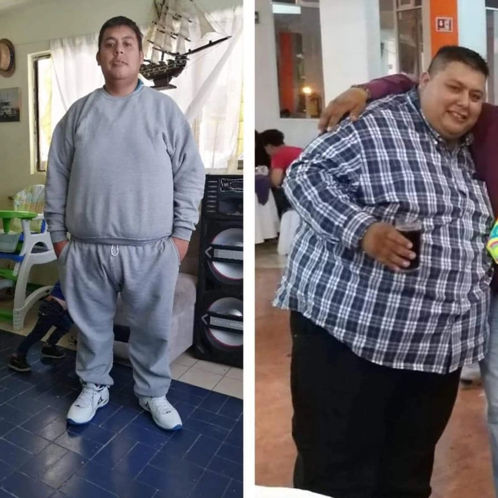 Antes y después de un paciente de la Dra. Sujey Romero