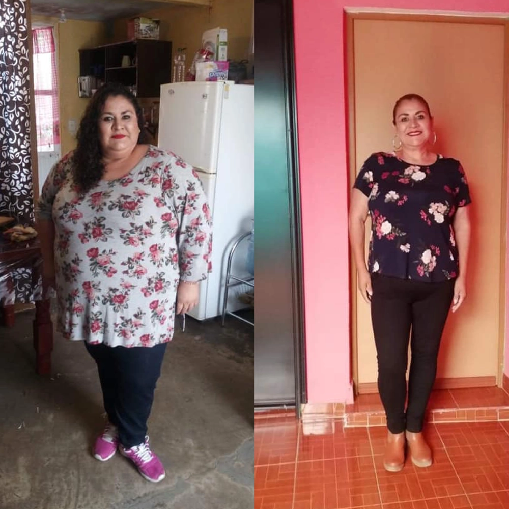 Antes y después de una paciente de la Dra. Sujey Romero